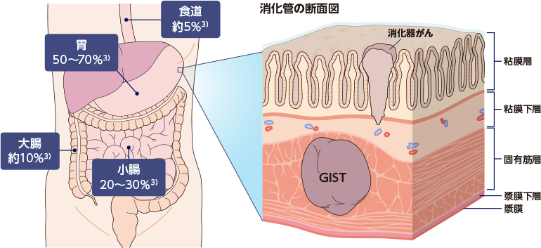消化管間質腫瘍（GIST）とは